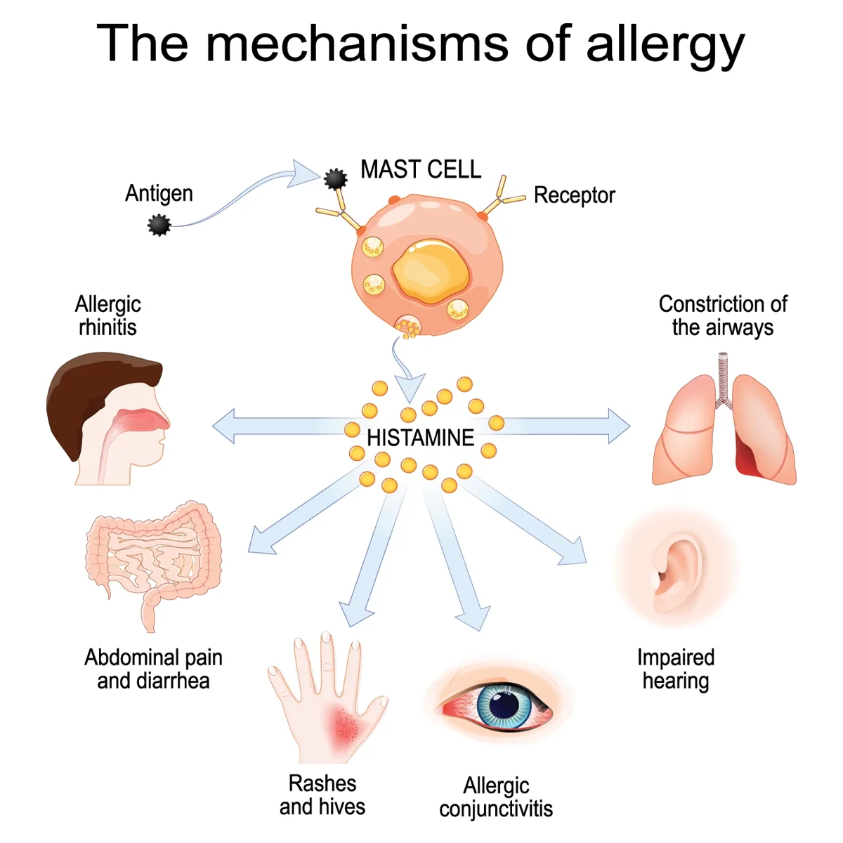 Image shows different symptoms of an allergic reaction: constriction of the airways, impaired hearing, red and itchy eyes, rashes and hives, abdominal pain and diarrhea, and running or stuffy nose.