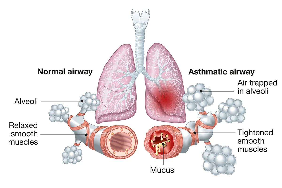 Image shows healthy airways on the left. On the right it shows an airway affected by asthma with mucus, tightened smooth muscles and air trapped in alveoli.