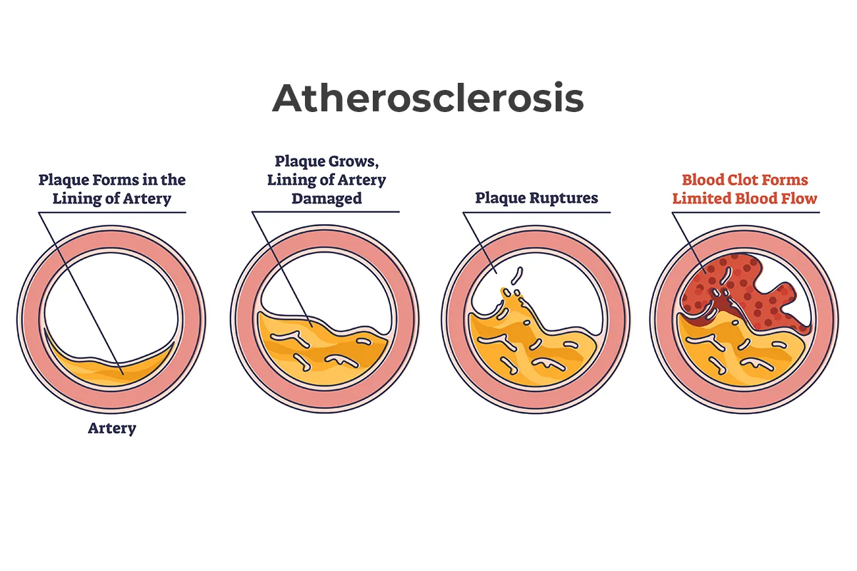 The image shows four steps in the progression of atherosclerosis from plaque forming in the artery to a blocked artery with a blood clot and limited blood flow.