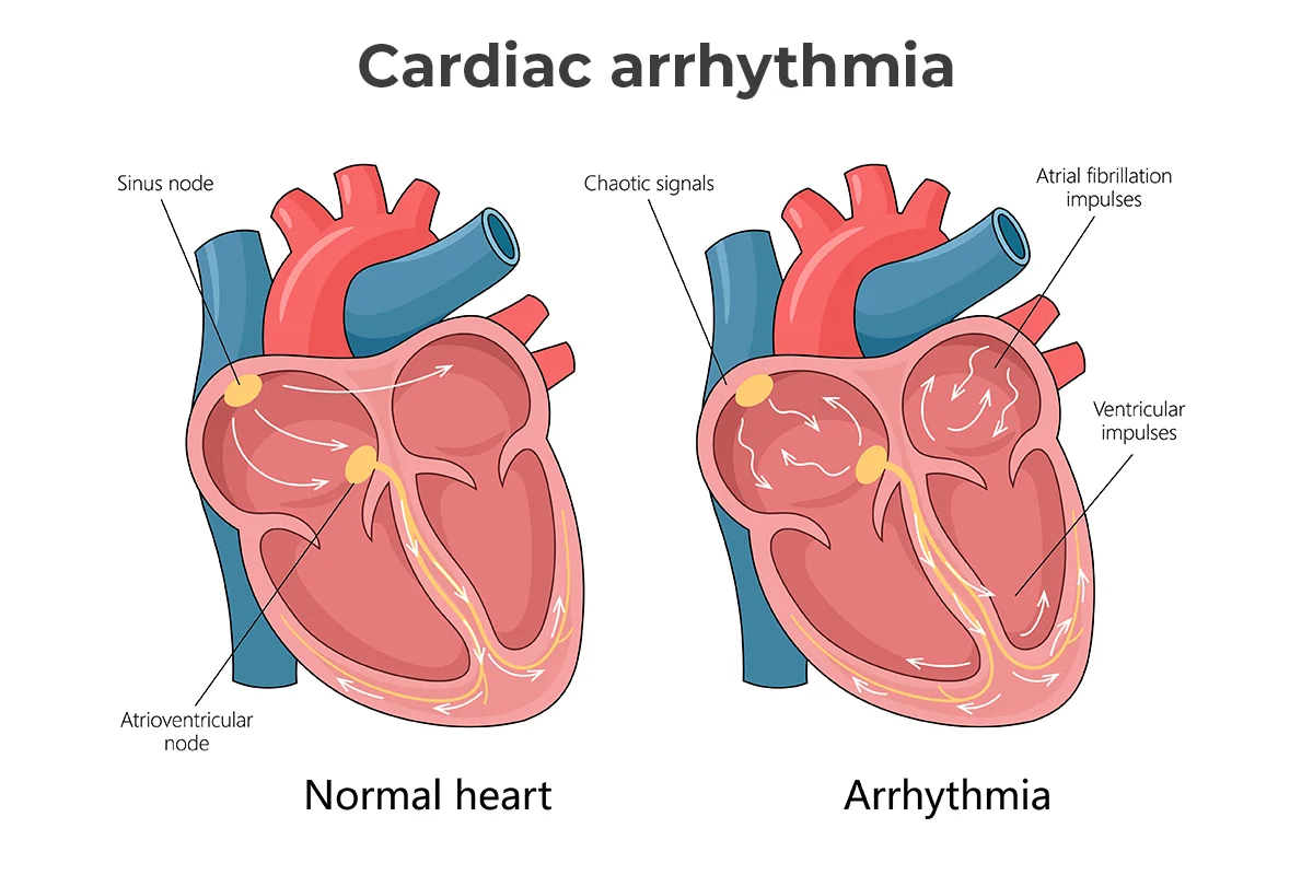 Image shows healthy heart rhythms and a heart with abnormal rhythms.