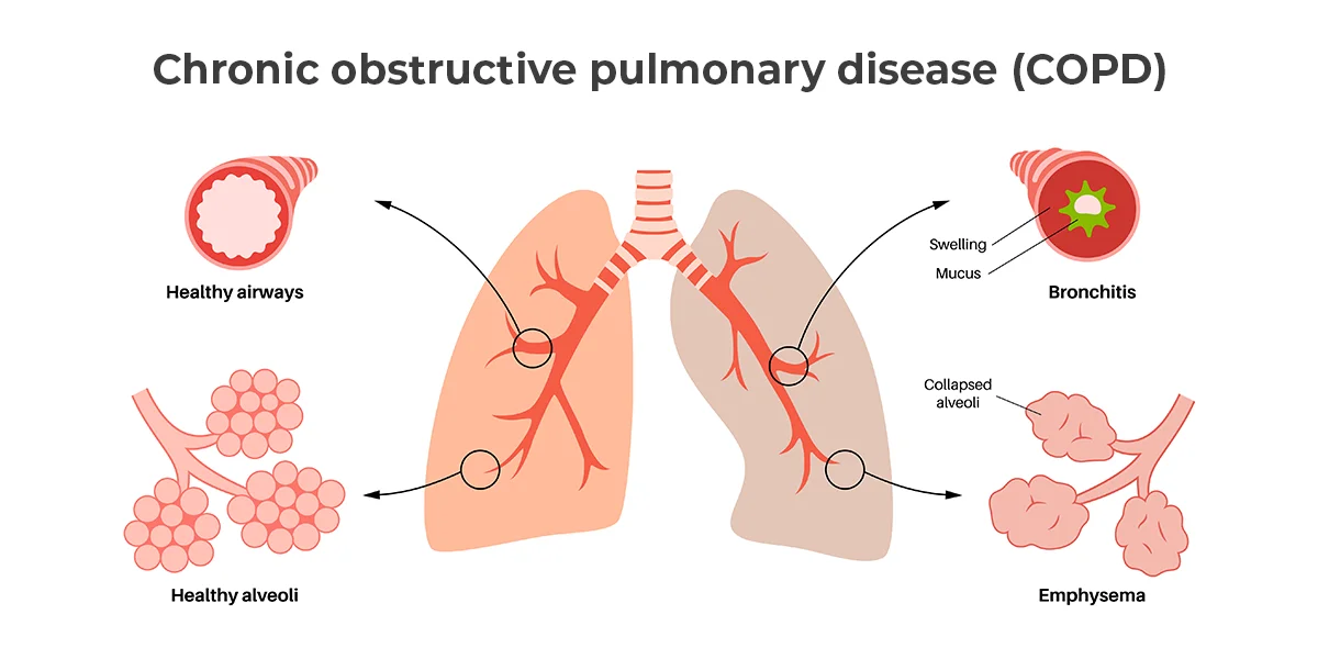 Image shows the lungs with COPD.