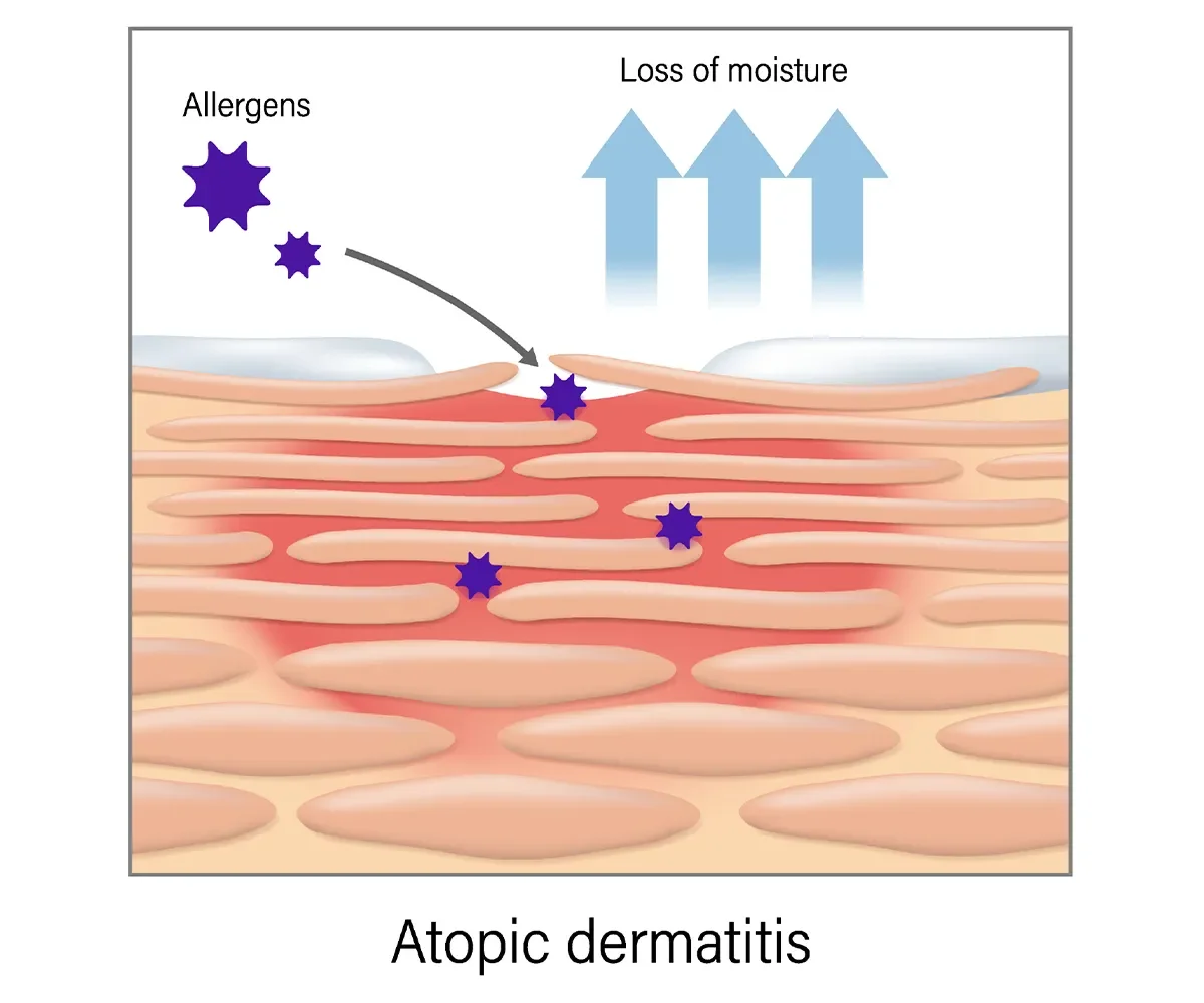 Image shows the action of allergens connected to eczema.