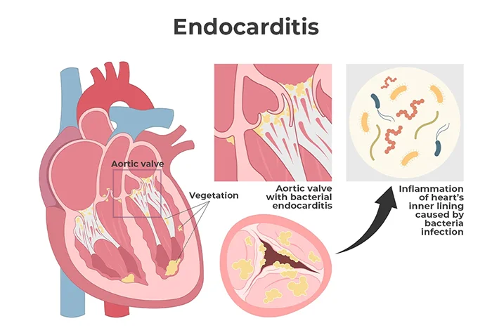 Image shows how bacterial endocarditis grows on the lining of the heart, causing inflammation.