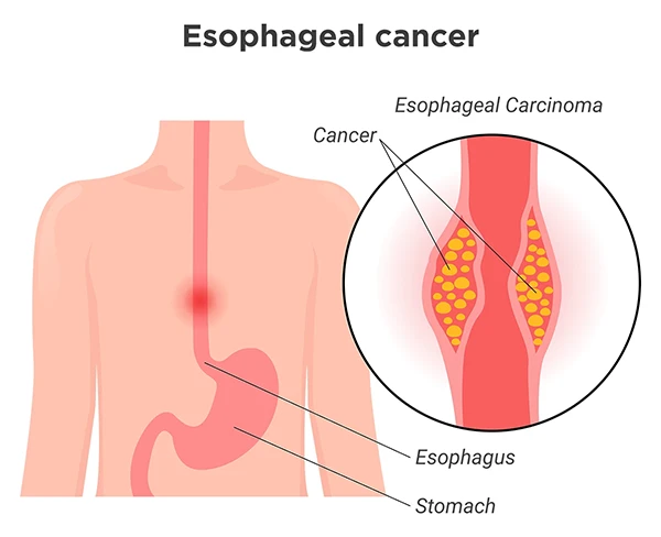 Image shows how esophageal cancer starts in the lining of the esophagus.