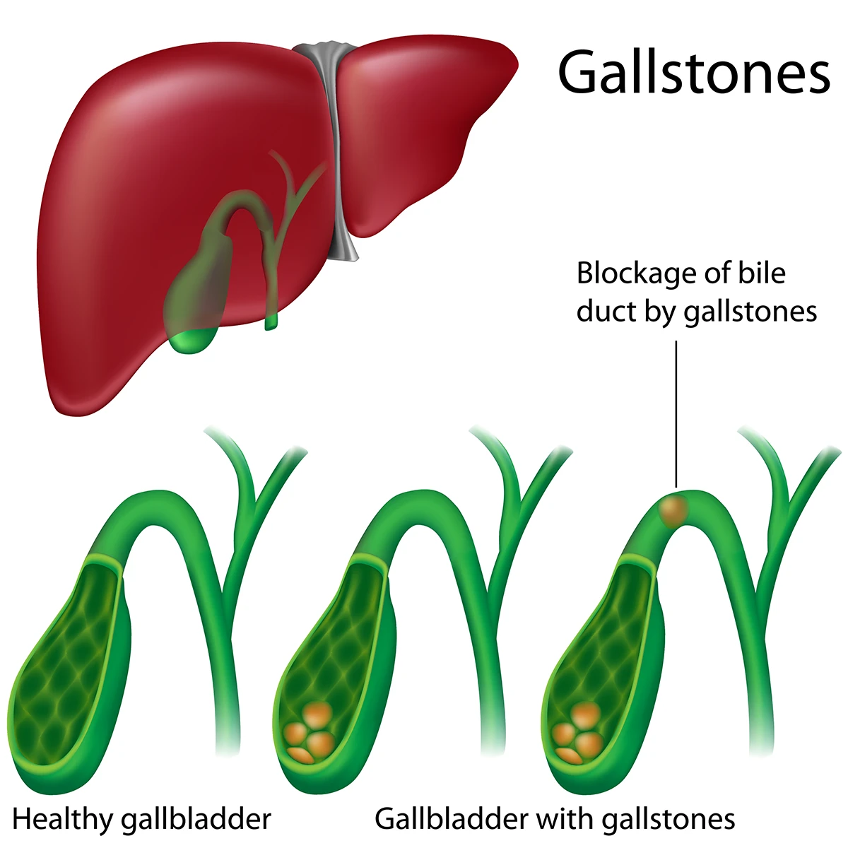  Image shows gallstones and how they may block the bile ducts in the gallbladder