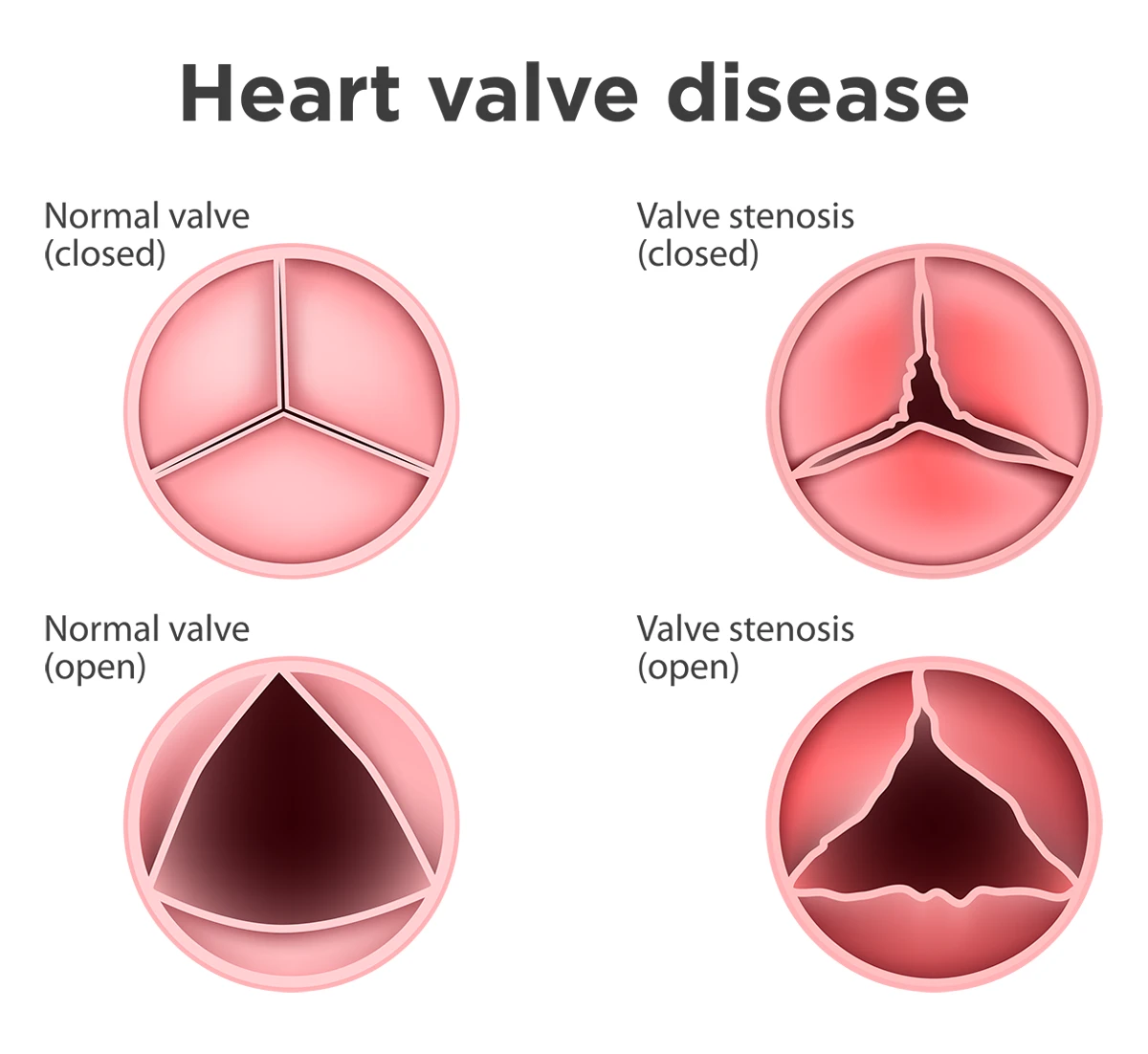 Illustration of a normal valve and a valve with stenosis, which is one type of heart valve disease. It shows the difference between how much a normal valve opens and closes compared to how much a valve with stenosis opens and closes. 