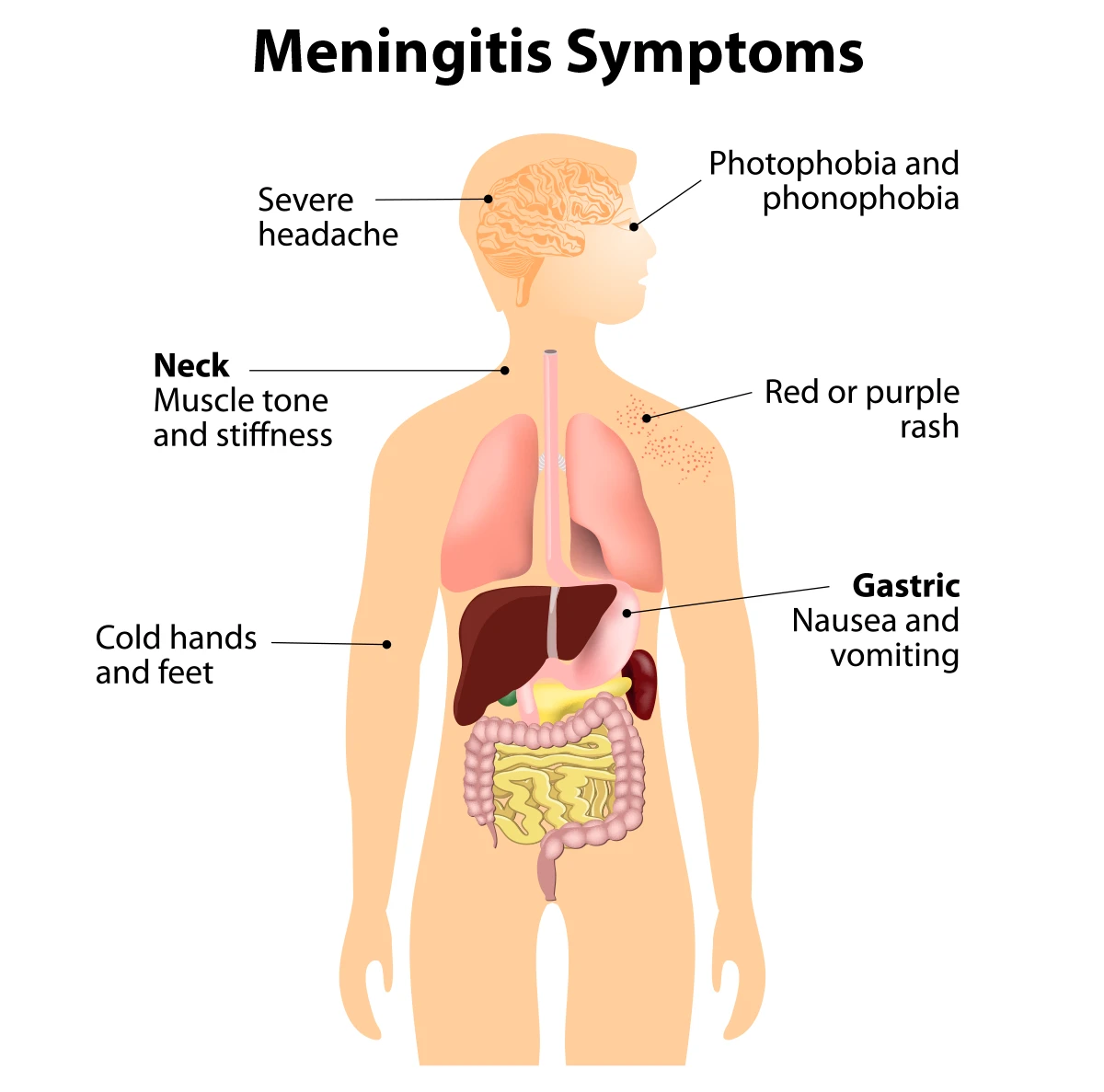  Image shows common symptoms of meningitis: cold hands and feet, neck muscle tone and stiffness, severe headache, photophobia and phonophobia, red or purple rash, and nausea and vomiting. 