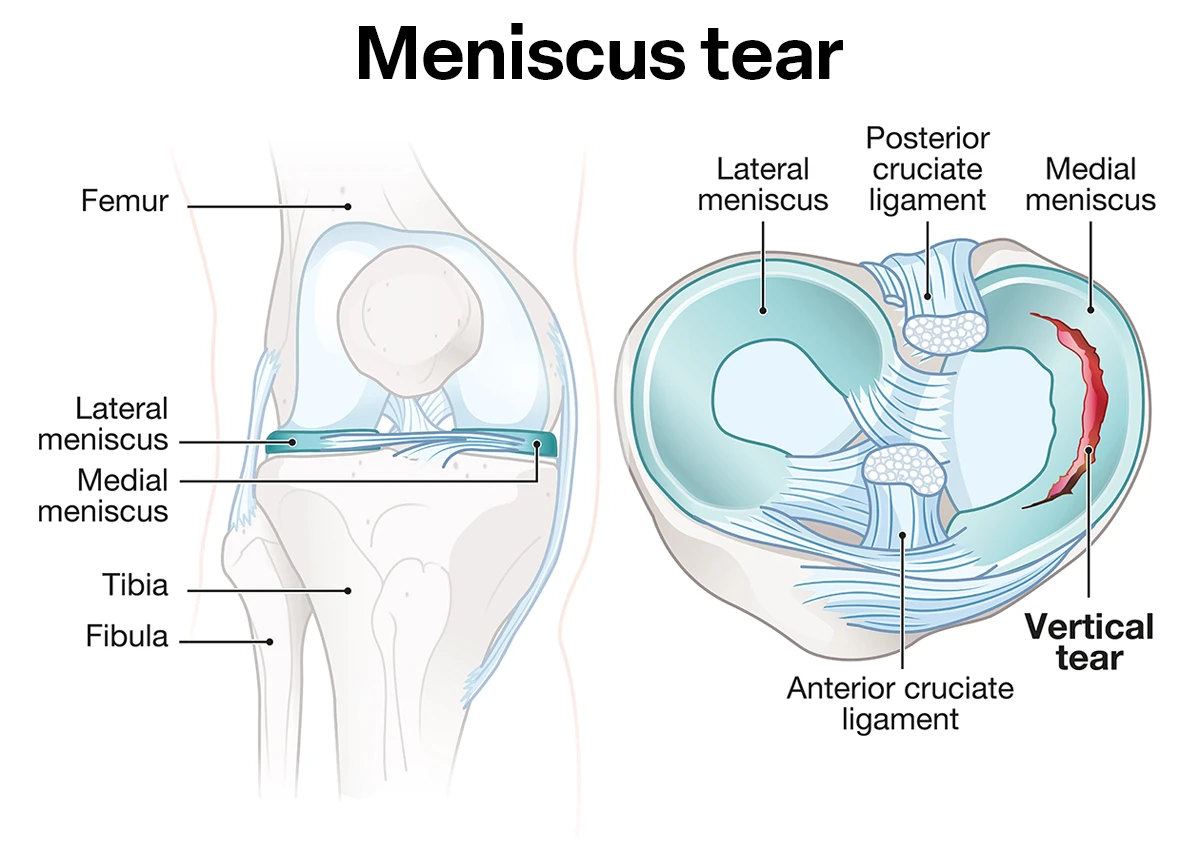 Left image shows the bones of the right knee from the front, with the healthy lateral meniscus and medial meniscus fitting between the upper and lower bones of the joint. Right image shows the menisci as a cross section from above, with a vertical tear in the medial meniscus. 
