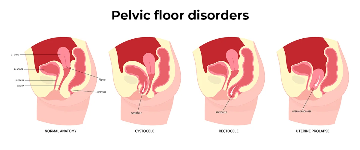 Illustrations of cystocele (prolapsed bladder), rectocele (prolapsed rectum) and uterine prolapse