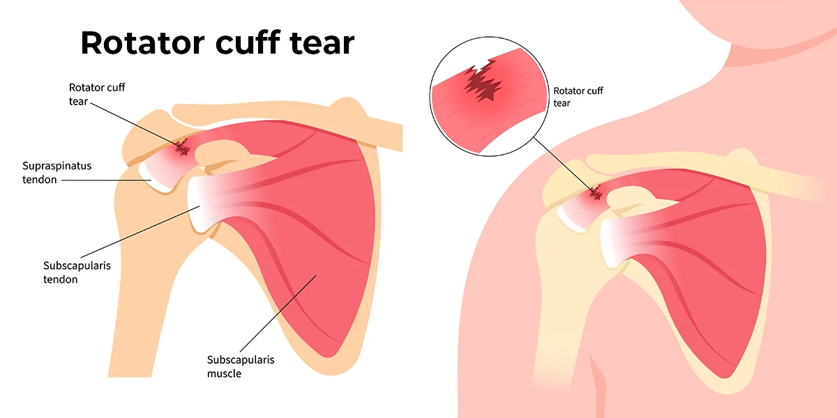 Image shows the tear of muscle fibers in the shoulder.