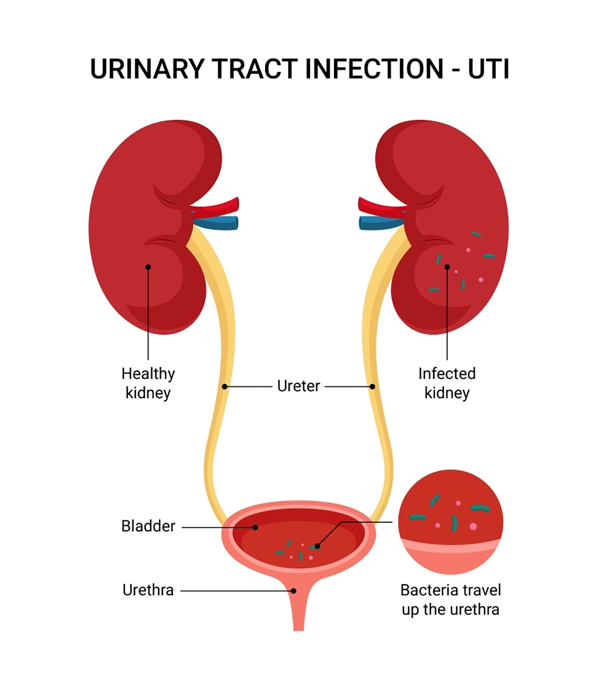 Illustration of the urinary tract, including a healthy kidney and an infected kidney, with bacteria shown traveling up the urethra to the bladder, ureter, and into the infected kidney.