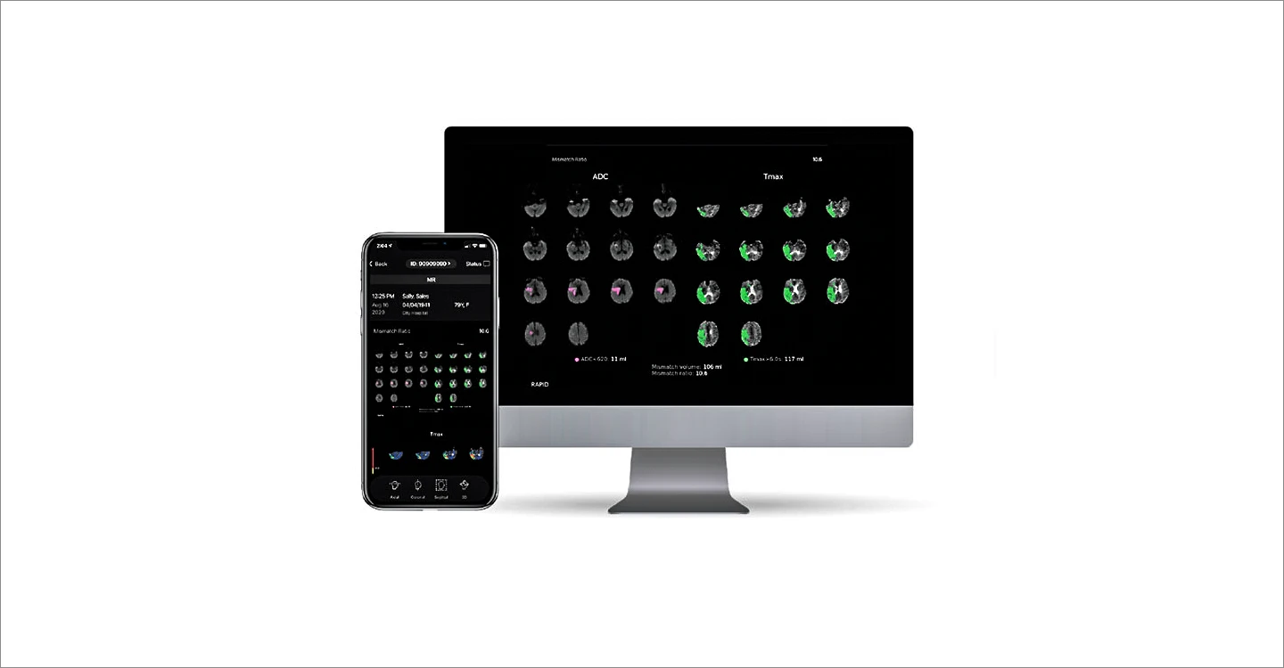 New Technology Playing Role in Diagnosing Strokes