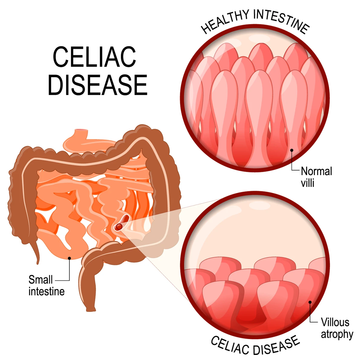 celiac disease damage